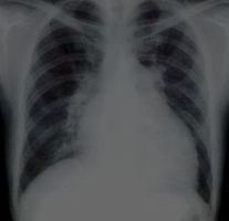 拡張型心筋症(胸部X線)