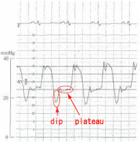 dip and plateau