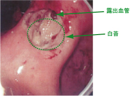 胃・十二指腸潰瘍