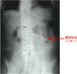 腸閉塞の腹部単純X線写真
