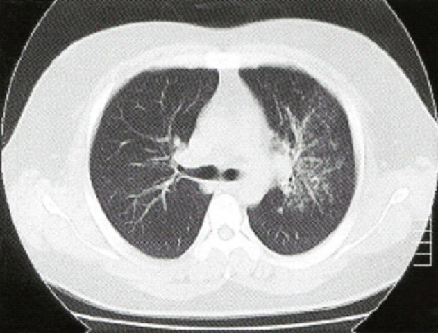 マイコプラズマ肺炎CT